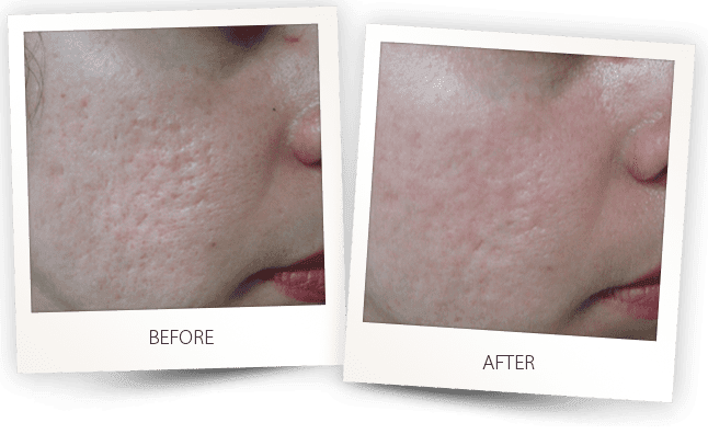 Acne scars revision by Alma