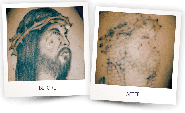 before and after laser tattoo removal treatment