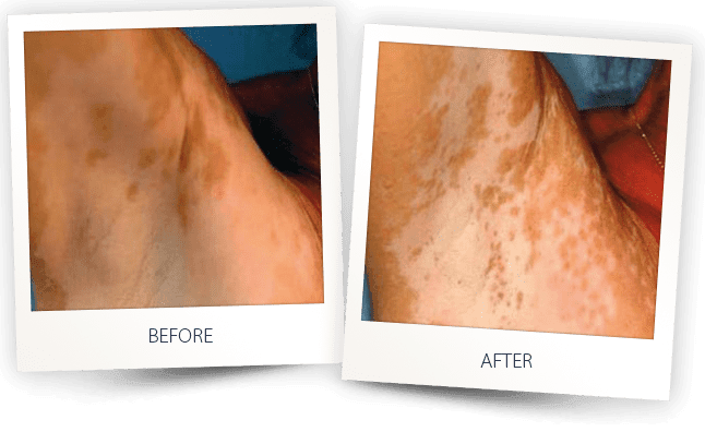 vitiligo skin discoloration laser treatment excimer