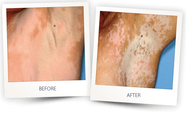 vitiligo skin condition laser treatment