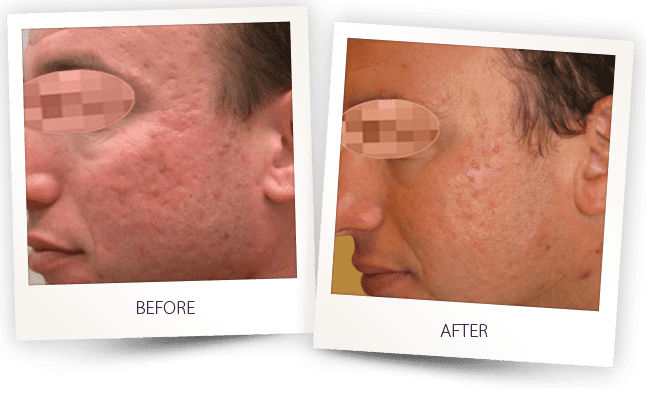 Acne scars removal laser treatment