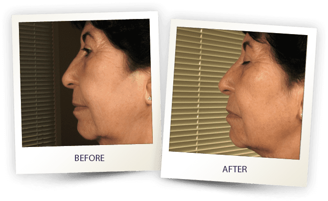face contouring by Alma - double chin treatment