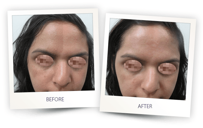 IPL laser treatment for skin hyperpigmentation