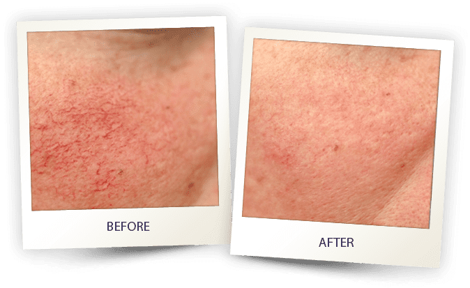 Laser Skin treatment - before and after - Noris Medical