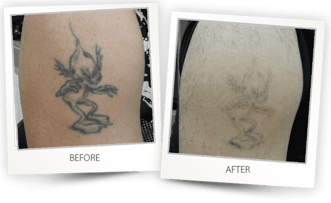 Tattoo Removal with ALMA Q