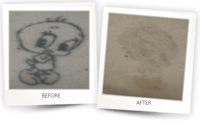 Tattoo Removal how to remove