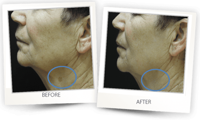 Pigmented lesion skin hyperpigmentation treatment