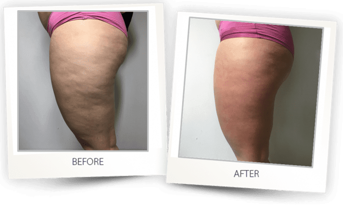 Before and after Cellulite treatment photos