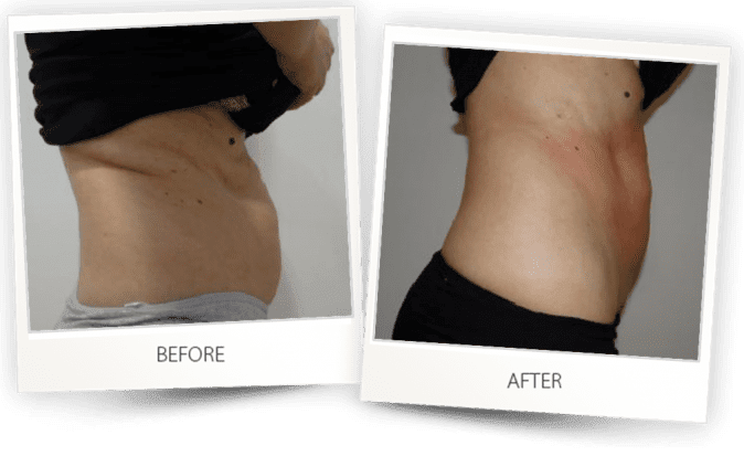 Body contouring with Accent Prime