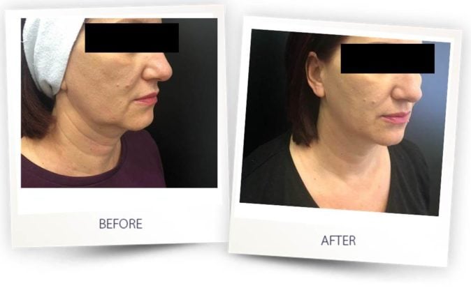 Before and After Face Contouring treatment