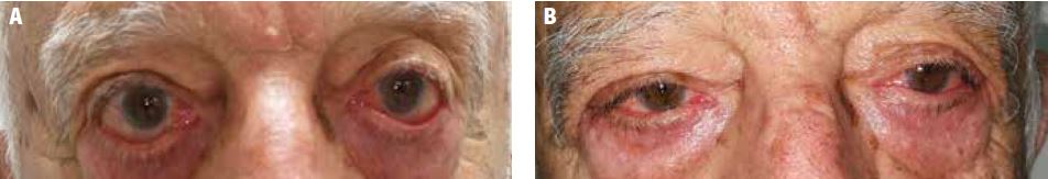 Blepharoplasty with CO2 before and after