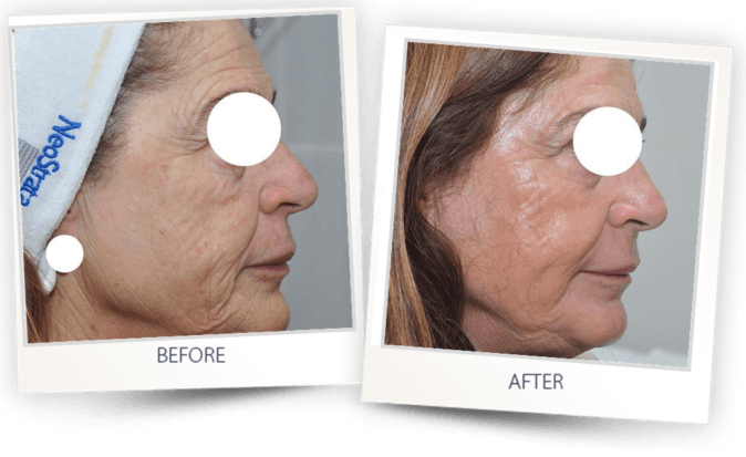 before and after - skin resurfacing with Pixel CO2 laser