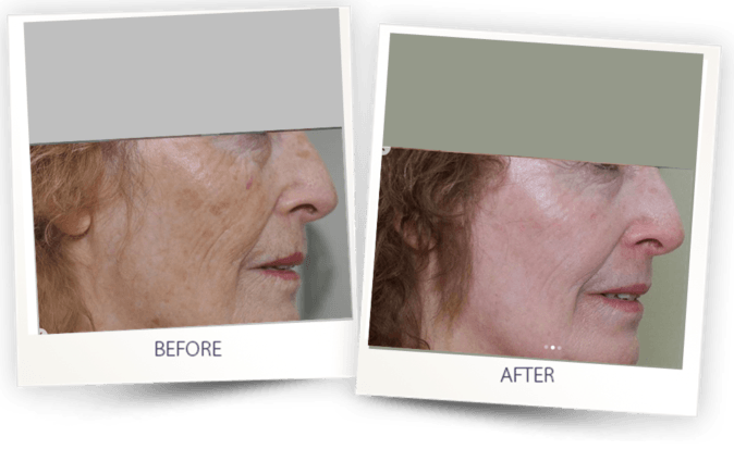 anti aging - skin resurfacing with Pixel CO2 laser
