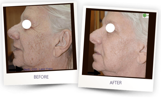 before and after - skin resurfacing with Pixel CO2 fractional laser