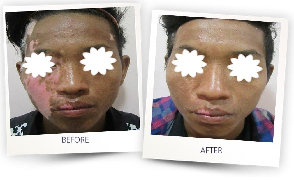 vitiligo skin discoloration laser treatment before uvb therapy