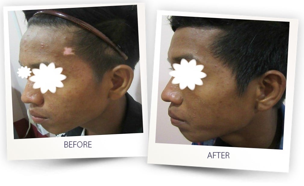 vitiligo skin disease laser treatment by Alma