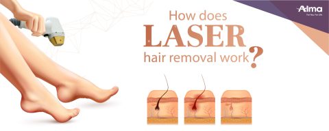 laser hair removal machine - Alma Lasers India