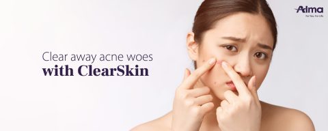 Clear away acne woes with ClearSkin