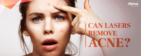Can lasers remove acne