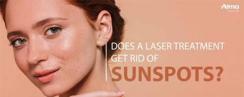 Does a laser treatment get rid of sunspots?