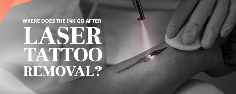 Where does the ink go after laser tattoo removal?